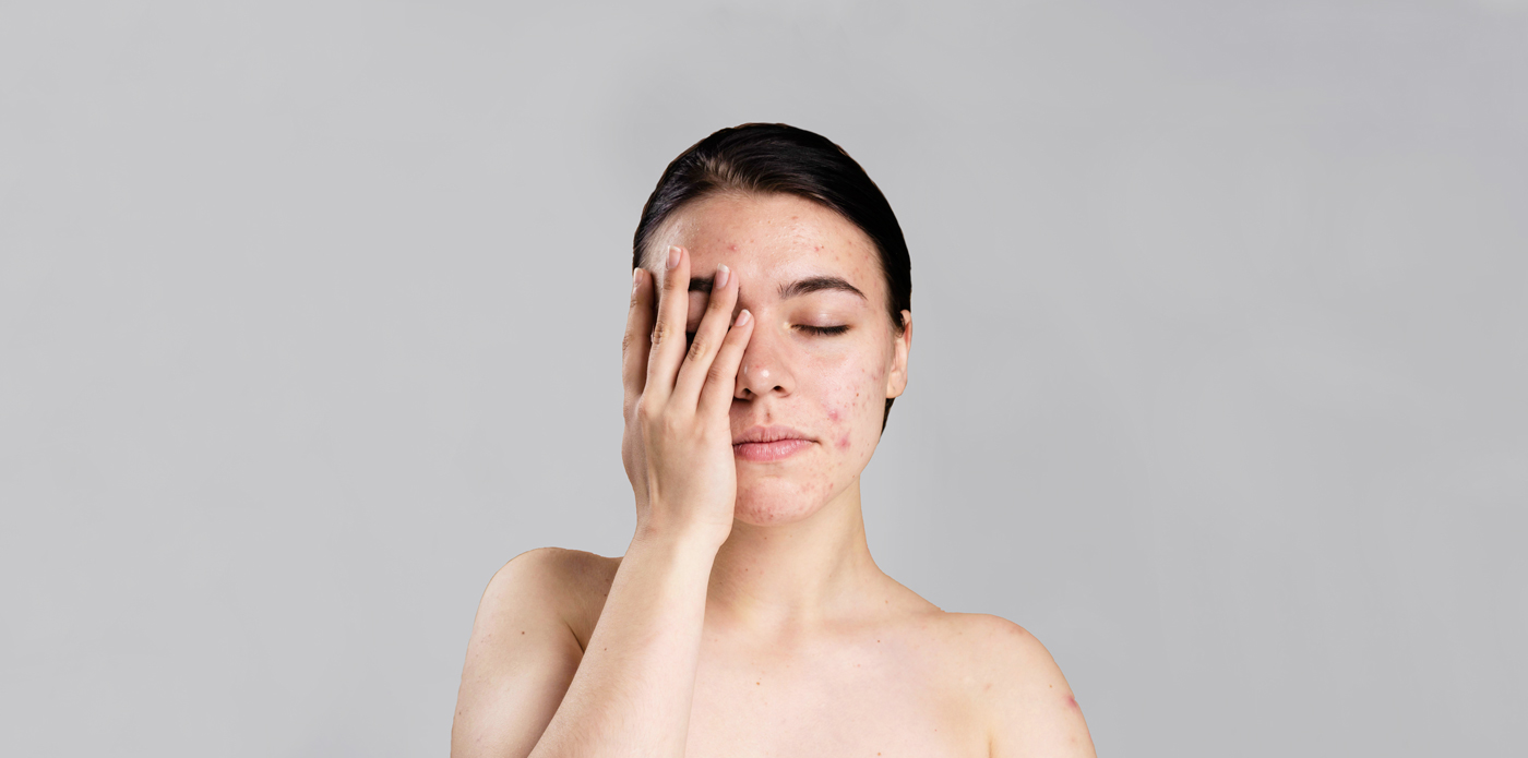 Лечение акне (прыщей) в Киеве | МЦ Лелека