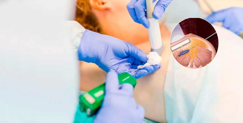 Тонкоголкова аспіраційна пункційна біопсія (ТАПБ) в Києві | МЦ Лелека Тонкоголкова аспіраційна пункційна біопсія (ТАПБ) в Києві | МЦ Лелека