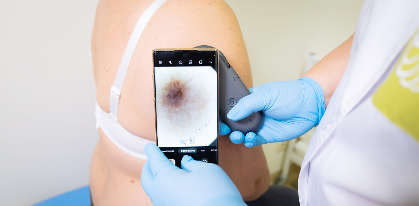 Видалення родимок на Печерську та на Оболоні в Києві | МЦ Лелека