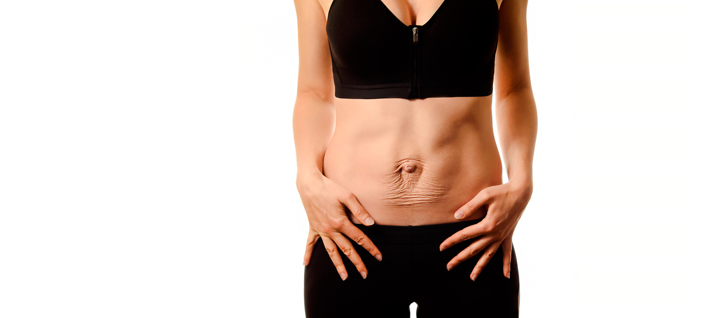 Лікування діастазу прямих м’язів живота у Києві | МЦ Лелека