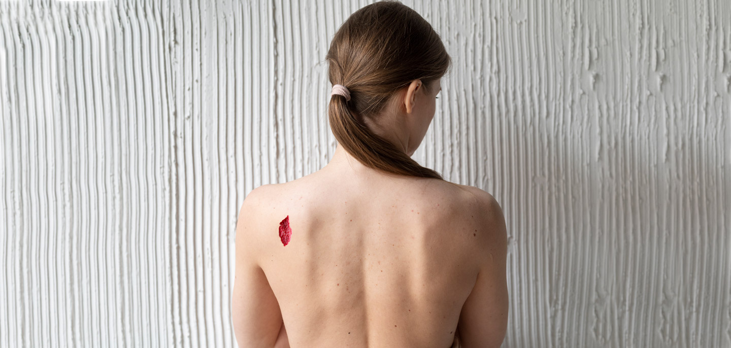 Видалення гемангіоми в Києві | МЦ Лелека