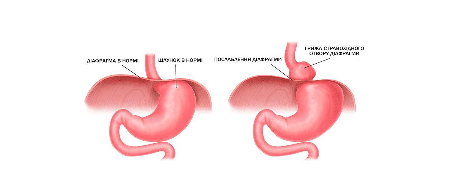 Видалення діафрагмальної грижі живота в Києві | МЦ Лелека Видалення діафрагмальної грижі живота в Києві | МЦ Лелека
