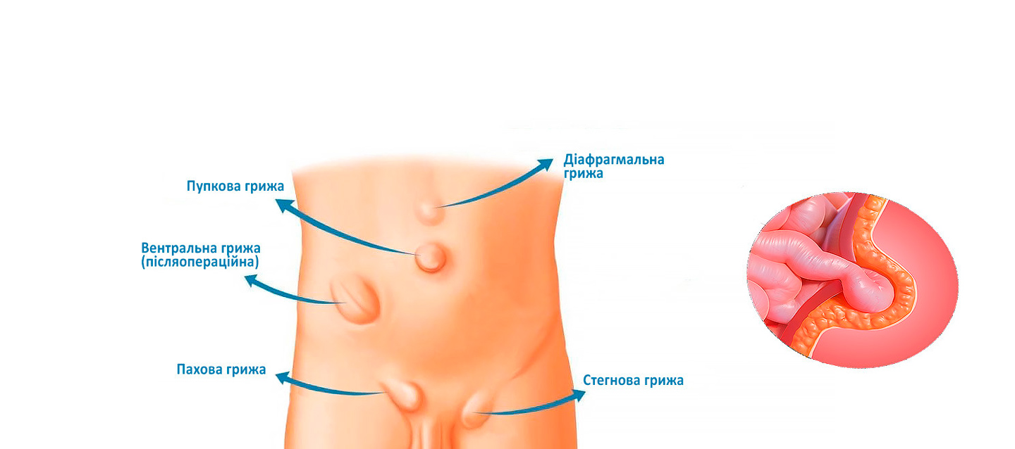 Видалення вентральної грижі живота в Києві | МЦ Лелека