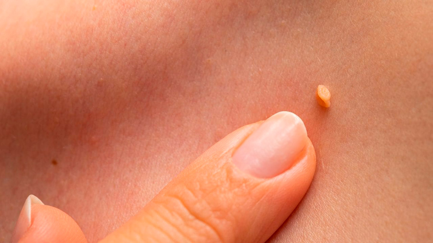 Бородавки, папіломи, кондиломи: видалення в Києві | МЦ Лелека