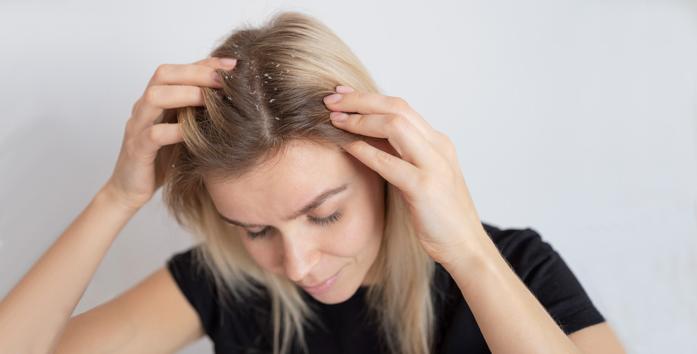 Себорейный дерматит (себорея): лечение в Киеве | Лелека